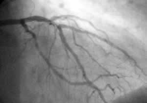 Do You Know What Angioplasty Is