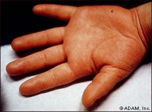 Is Kawasaki Disease Dangerous