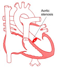 Learn The Signs Of Aortic Stenosis