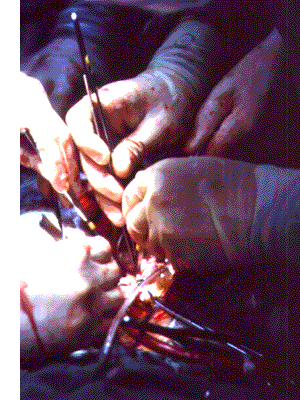 The Transplant Treatment For Heart Failure