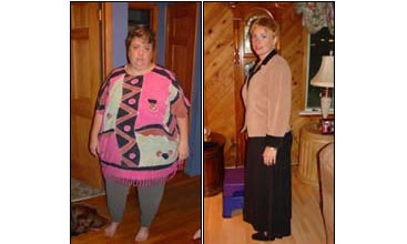 Weight Loss Pictures Of Lap-Band Surgery