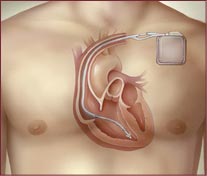What Is A Implantable Cardioverter Defibrillator