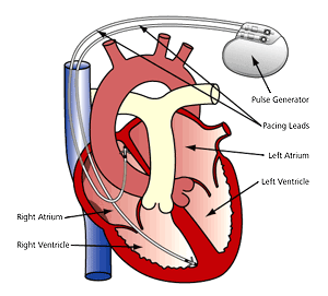 Who Needs A Pacemaker