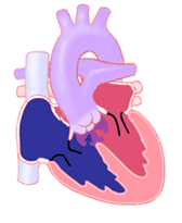 Learn About Truncus Arteriosus